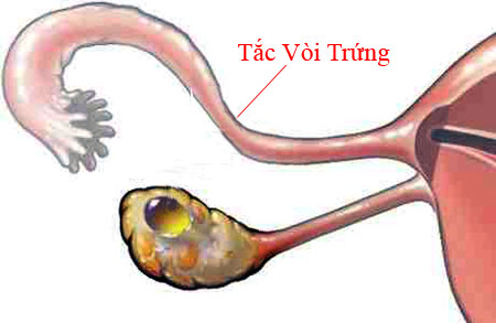 http://khamdakhoa.net/media/images/benh-buong-trung/benh-tac-voi-trung-01.jpg