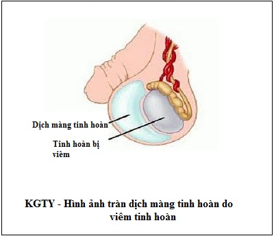 Bệnh viêm tinh hoàn