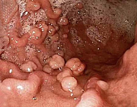 nguyen-nhan-gay-polyp-hau-mon