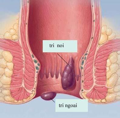 Triệu chứng bệnh trĩ ngoại