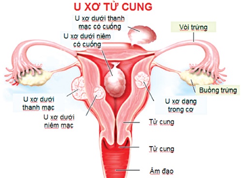 u-xo-tu-cung-co-nguy-hiem-khong