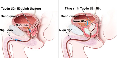 benh-phi-dai-tuyen-tien-liet-la-gi