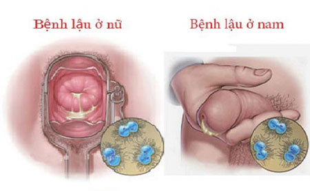bệnh lậu ở nam và nữ giới
