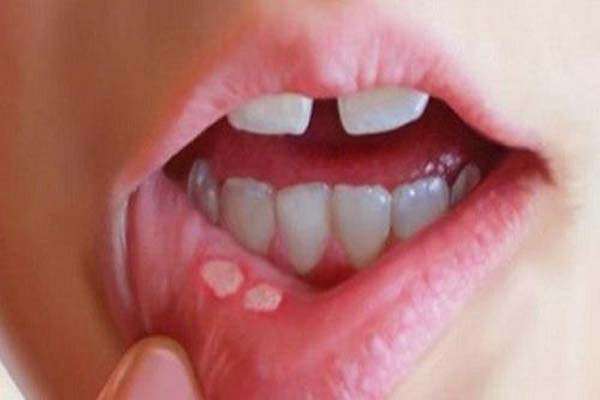 bệnh sùi mào gà ở miệng