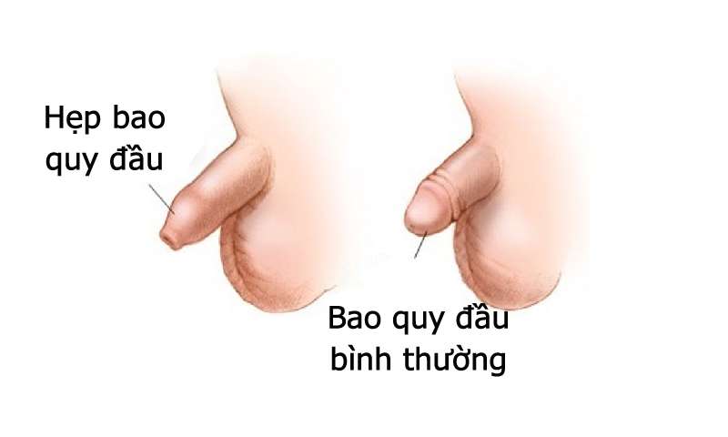 hình ảnh hẹp bao quy đầu