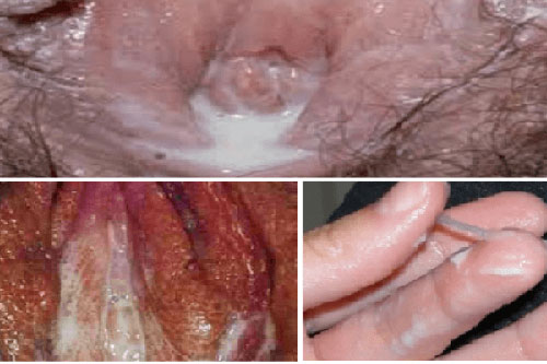 triệu chứng bệnh lậu ở nữ