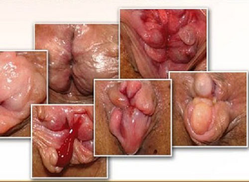 Hình ảnh bệnh lòi dom