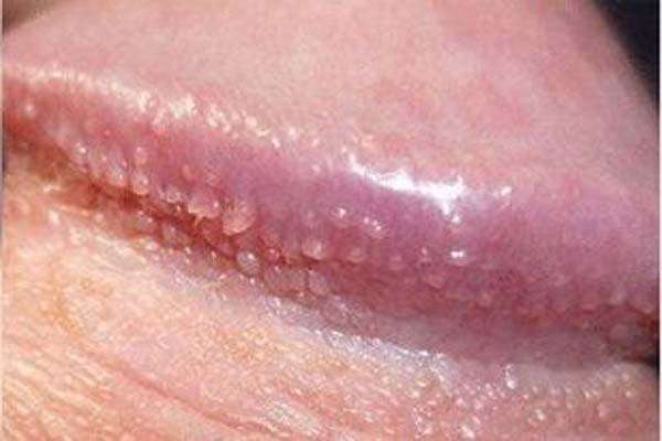 hình ảnh sùi mào gà ở nam giai đoạn đầu