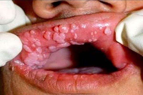 hình ảnh sùi mào gà ở miệng