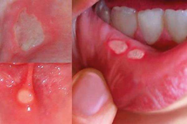 cách chữa nhiệt miệng