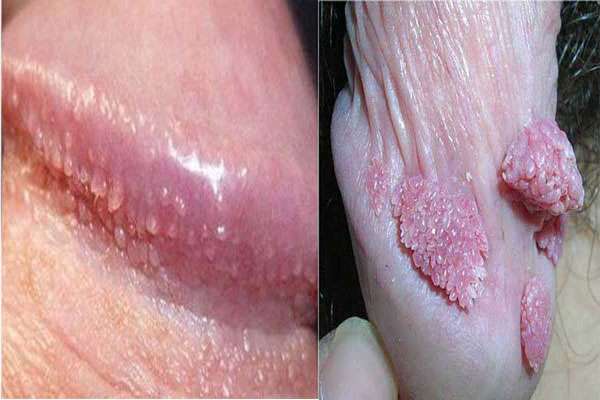 phân biệt chuỗi hạt ngọc dương vật với sùi mào gà