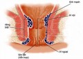 Bệnh trĩ là bệnh gì?