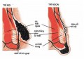 Nguyên nhân gây bệnh trĩ