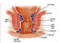 Thế nào là bệnh trĩ?