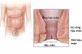 Dấu hiệu nứt kẽ hậu môn