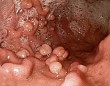 Nguyên nhân polyp hậu môn
