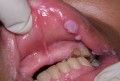 Bệnh sùi mào gà ở miệng