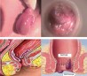 Điều trị trĩ nội độ nhỏ 1, 2