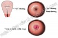 Điều trị viêm lộ tuyến cổ tử cung