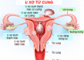 Nguyên nhân gây ung thư cổ tử cung