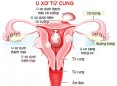 U xơ tử cung có nguy hiểm không?