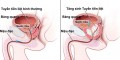 Bệnh phì đại tuyến tiền liệt là gì