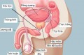 Bệnh viêm tuyến tiền liệt