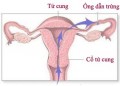 Bệnh tắc ống dẫn trứng