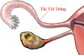 Bệnh tắc vòi trứng