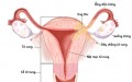 Bệnh viêm buồng trứng