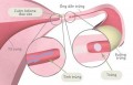 Bệnh viêm ống dẫn trứng