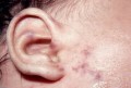 Chi phí xét nghiệm, chữa trị bệnh giang mai hết bao nhiêu tiền? Có đắt không?