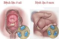 Bệnh lậu có chữa khỏi dứt điểm hẳn được không?