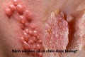 Bệnh sùi mào gà có chữa khỏi được không