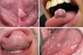 Sùi mào gà ở nam