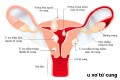 Mổ u xơ tử cung hết bao nhiêu tiền?