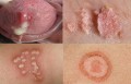 Tổng hợp các bệnh xã hội thường gặp và cách phòng tránh