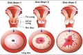 Cách điều trị ung thư cổ tử cung
