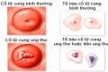 Những dấu hiệu ung thư cổ tử cung cần lưu ý