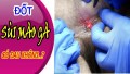 Đốt sùi mào gà có đau không