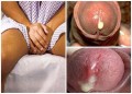 Dương vật chảy dịch mủ trắng đục là bệnh gì, có nguy hiểm không?