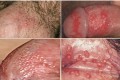 Dương vật nổi mụn trắng, đỏ kèm ngứa hoặc không là bệnh gì nguy hiểm không