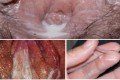 Bệnh lậu ở nữ giới có dấu hiệu, triệu chứng như thế nào?