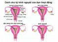 Không có kinh nguyệt là bệnh gì?