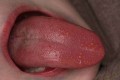 Cuống lưỡi nổi mụn đỏ nguyên nhân do đâu