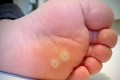 Mụn cóc là gì? Nguyên nhân, dấu hiệu nhận biết