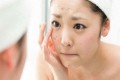 Các loại mụn thường gặp và cách trị mụn tại nhà