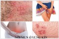 Nổi mụn ở vùng kín là bị bệnh gì?
