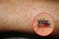 Bệnh sốt xuất huyết: nguyên nhân, dấu hiệu và cách phòng tránh