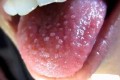 Sùi mào gà ở lưỡi: nguyên nhân, triệu chứng và cách chữa trị